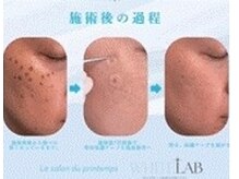 ホワイトラボ！人気急増中！施術の過程のイメージ♪