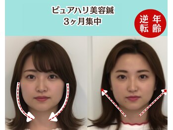 ピュアハリ/沖縄美容鍼/たるみ/効果