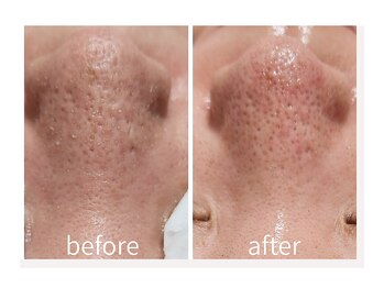 キレイラボ(Ki-Re-i LABO)/毛穴洗浄ハイドラ