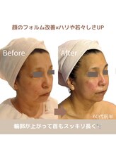 アンジェリカ(Angelica)/60代の手強いたるみケアもお任せ