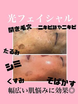 デスティン(Destin)/光フェイシャルでシミケアを♪