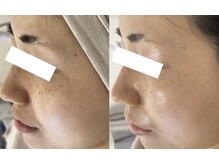 クラティス(CRATIS)/【レチノール】肌質改善艶肌質へ