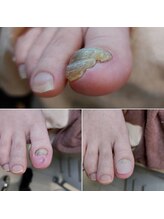 爪切り屋 足楽/爪甲鉤弯爪