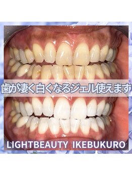 ライトビューティー 池袋店(LightBeauty)/症例写真