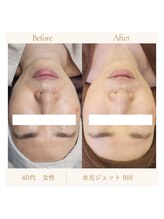 ラヴィエベル(la vie est belle)/フェイシャル＊水光ジェット