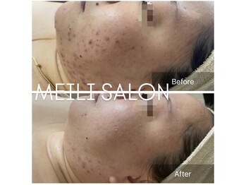 メイリー(MEILI)/ニキビケア10回効果