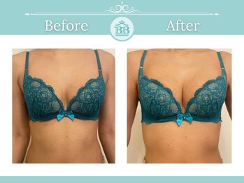 美人バスト 町田店/バストアップ◇症例◇