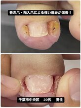 巻き爪じゅん 船橋店/巻き爪・陥入爪による痛みが改善