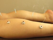 はり灸治療院 えがお/浮腫みに。