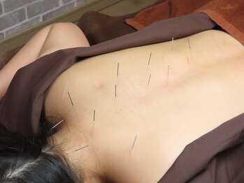 リッチョ鍼灸院(Riccio鍼灸院)/首・肩こり・腰痛 鍼灸施術