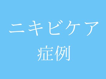 ビープラス(BEE PLUS)/美容鍼でのニキビケア