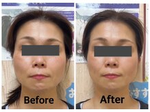まごころ整骨院の雰囲気（電気美容鍼＋ヘッドマッサージbefore＆after(ワンクール施術)）