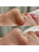 ヨハク 市川店(yohaku)/毛穴洗浄