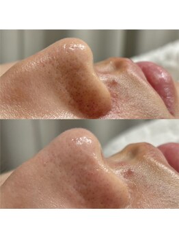 ヨハク 市川店(yohaku)/毛穴洗浄