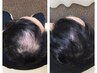 鍼で頭皮の凝り撃退!!【育毛促進＆脱毛緩和】★初回限定¥7,980