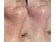 チュチュ(TUTU)の写真/あなたの毛穴の原因は何？毛穴洗浄もWAX脱毛も原因を見極めて最適ケアをご案内！毛穴レスのちゅる肌へ♪
