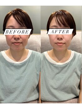 シロ(silo.)/幹細胞導入