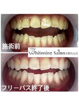 ホワイトニングサロン 京都烏丸店/ホワイトニング施術例