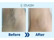 ストラッシュ 浜松店(STLASSH)/施術例：脇