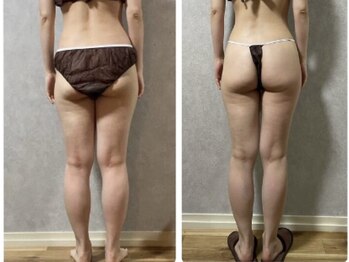 スリーピングビューティー(Sleeping Beauty)/インディバ　下半身痩せ！