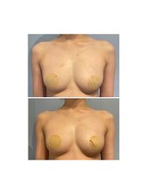 ルナグランデ 心斎橋店(Luna grande.)/脂肪を増やしてボリュームUP