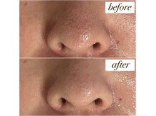 ミュー(myu)の雰囲気（何をしても変化を感じにくい毛穴の開きに）