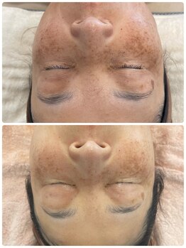 クラティス 塩尻店(CRATIS)/高濃度エクソソーム