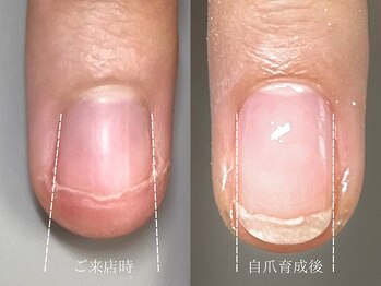 爪悩み専門店/2ヶ月のビフォーアフター