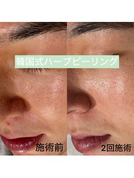 シュエット(Chouette)/韓国式ハーブピーリング