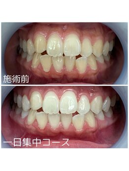 ホワイトニングサロン 京都烏丸店/ホワイトニング施術例