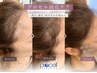 【希少◆プロセルセラピーズ】うす毛トリートメント¥50000→40000