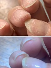 ピンクのラナンキュラス/施術前/施術後