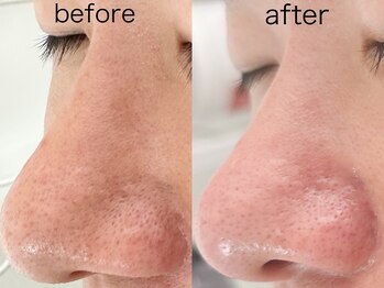 アトレ アンド ミューズ(Attrait×Muse)/ハイドラ毛穴洗浄(パック付)