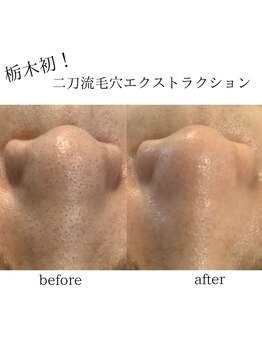 カンパニュラ(campanula)/#毛穴エクストラクション