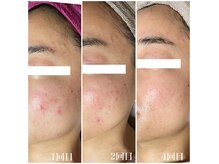 りらく洞 ゆうなの雰囲気（ハーブピーリングでニキビケア、毛穴ケア、キメを整え艶肌美人へ）