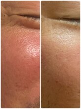 ステラフィールド(stella field)/プラズマカリファ　