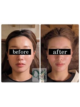 キュープ 群馬吉岡店(Qpu)/Vラインもお手の物☆小顔矯正