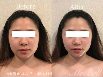 ミベル(MeBell)/【小顔コルギ】施術1回