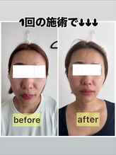 リリースパ 辻堂店(Lily spa)/【韓国肌質改善】30代から始める