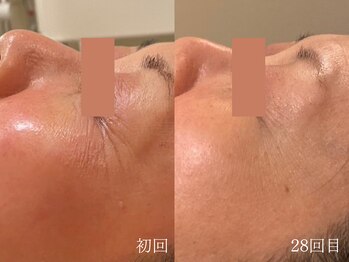 ウォーム(warm)/シワケア/小顔/マッサージ/小顔