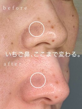 テン 仙台(10n.)/水光ピール施術後