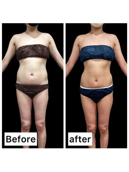 クールヴィラ(Cool Villa)/下腹2カップ×4回