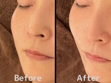 氣生/ハーブピーリングでむくみも改善