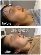 ビンナ 五反田店(Binna)/小顔&トーンアップならこれ♪