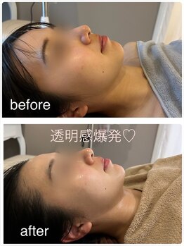 ビンナ 五反田店(Binna)/小顔&トーンアップならこれ♪