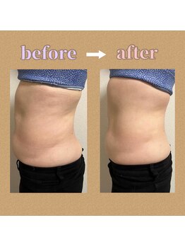 ベリーチェ(beliece)/《痩身》脂肪分解/ウエスト