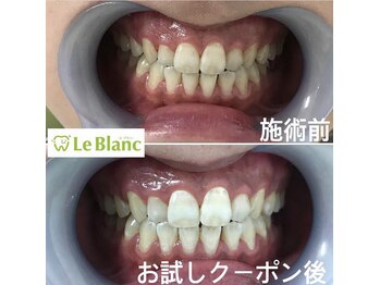 ルブラン 奈良店(Le Blanc)/前歯にある白い模様なモノは。。