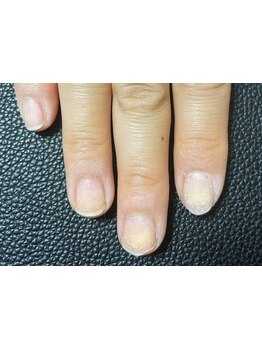 爪の悩みを解消できる（ケア含む）