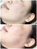 毛穴の詰まりと産毛を一掃☆お肌が綺麗になるフェイスワックス　