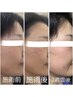 ニキビ肌の方も◎【シミケア】夏限定！当店大人気◎光フェイシャル♪6500円